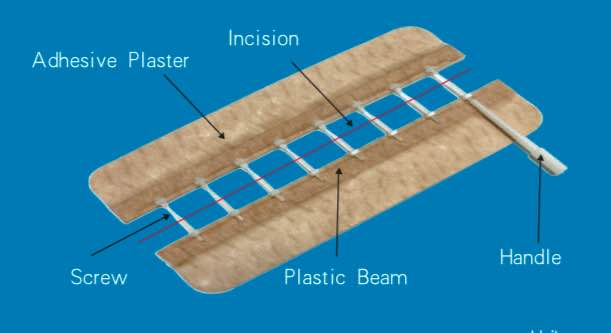 SURGICAL SKIN CLOSURE